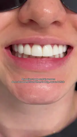 In this case I removed 10 upper porcelain veneers which were done abroad and replaced them with 10 direct composite veneers in a more natural shape. My patient will return in the near future for the lower porcelain veneers to be replaced in the same way 🤍
