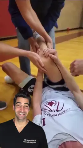 Here's a comprehensive breakdown of the diagnosis and treatment/reduction of a lateral patella dislocation, including immediate steps and follow-up care. ✅ Lateral Patella Dislocation: Overview Definition:A lateral patella dislocation occurs when the kneecap (patella) moves out of its normal position in the trochlear groove of the femur, almost always laterally (to the outside of the knee). It often results from a twisting injury, a direct blow, or a sudden directional change—especially in sports. Most common demographic: * Adolescents and young adults * Females greater then males * Sports or traumatic injury-related 🧠 Mechanism of Injury * Non-contact: Twisting or pivoting on a planted foot with knee in slight flexion * Contact: Direct blow to the medial aspect of the patella * Anatomical predisposition: Patella alta, trochlear dysplasia, increased Q angle, generalized ligamentous laxity 🔍 Diagnosis 1. Clinical Presentation * Sudden, severe pain with deformity * Obvious lateral displacement of the patella (in locked dislocations) * Difficulty bearing weight * Knee held in slight flexion * Swelling/effusion (hemarthrosis may develop quickly) 2. Physical Exam * Lateral displacement or palpable defect medially * Tenderness along the medial retinaculum * Apprehension sign (fear/pain with lateral patellar movement during exam) * Evaluate for associated ligamentous or osteochondral injury 3. Imaging * X-ray (AP, lateral, sunrise/Merchant view):     * Confirm dislocation or rule out fracture (especially osteochondral avulsion) * MRI:     * Evaluates MPFL tear, cartilage damage, loose bodies, or predisposing anatomical abnormalities ⚡️ Immediate Management: Reduction Closed Reduction (if still dislocated): * Patient in supine position with relaxed quadriceps * Gently extend the knee while applying medial pressure to the patella * Often spontaneously reduces during gentle knee extension Post-reduction: * Confirm with repeat X-ray * Check for joint stability * Assess neurovascular status 🧊 Initial Treatment After Reduction 1. Immobilization:     * Knee immobilizer or hinged brace in extension for 2–3 weeks     * Weight-bearing as tolerated with brace 2. Ice & Elevation:     * Reduce swelling and pain 3. NSAIDs:     * For pain and inflammation 4. Crutches:     * May be used short-term depending on patient comfort and stability 🏃‍♂️ Rehabilitation Phase Week 2–6: * Physical therapy focused on:     * Range of motion     * Quadriceps strengthening (esp. vastus medialis obliquus – VMO     * Proprioception and neuromuscular control 6+ Weeks: * Gradual return to sport if no recurrent instability * Functional testing before clearance 🚨 When to Refer or Consider Surgery Refer to Ortho if: * First-time dislocation with large osteochondral fracture * Loose body in the joint * Recurrent dislocations (especially with anatomical risk factors) * Failure of conservative treatment Surgical Options: * MPFL repair or reconstruction * Tibial tubercle transfer (TTT) * Trochleoplasty (in cases of severe dysplasia) * Arthroscopy for loose body removal 📋 What to Do If It Happens (Field/At Home) 1. Do not force movement. 2. Immobilize the leg in the position found (usually slight flexion). 3. Transport to ER or urgent care for reduction (if not spontaneously reduced). 4. Apply ice and elevate the limb. 5. Do not return to activity until cleared by a provider—risk of re-dislocation is high without rehab. 💡 Prognosis * Good with conservative management in first-time dislocations (90% return to sport) * High recurrence (up to 30–50%) in younger athletes or with predisposing factors * Surgery reduces recurrence in chronic instability #sports #basketball #athletics #PatellaDislocation #KneeInjury #Orthopedics #SportsMedicine #KneePain #PatellarInjury #MPFLTear #PhysicalTherapy #InjuryRecovery #KneeRehab #OrthoTips #DislocatedKneecap #AthleteInjury #KneeStability #OrthoEducation