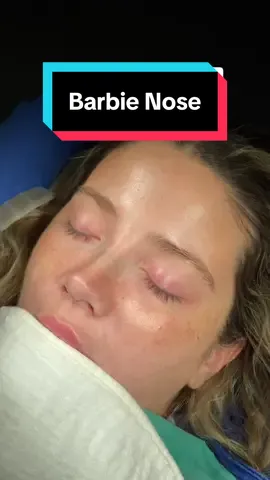 #barbienose #rhinoplasty #rhinoplastyturkey #nosejob #rhinoplastyistanbul #nosejobcheck #rinoplastia #nasenkorrektur 