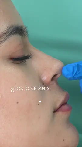 ✨ Hay personas que después de usar brackets se ven radicalmente mejor… pero nadie sabe por qué. Y no, no es solo por los dientes. Es algo que transforma tu perfil, tu armonía… tu imagen completa. ¿Quieres ese efecto wow sin necesidad de retoques? 🚨 Este video te lo explica todo. Agenda tu cita y prepárate para verte como nunca antes. #Quito #Ecuador #OrtodonciaEstética #GlowUp #Brackets