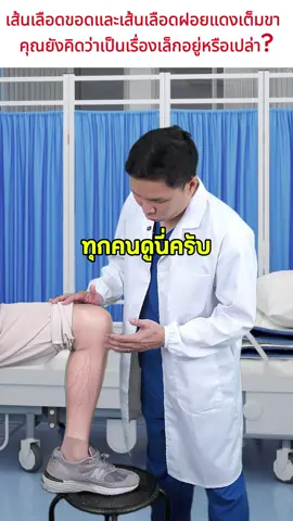 เส้นเลือดขอด ขาไส้เดือน เส้นเลือดแดงหนาแน่น วิธีใหม่ 2025 รีบใช้เลย!