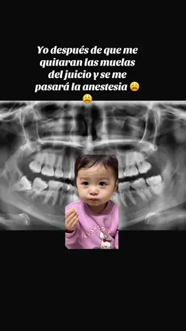 No lo recomiendo hacer pecas #Meme #MemeCut #muelasdeljuicio #maxilofacial #dolores #fyp 