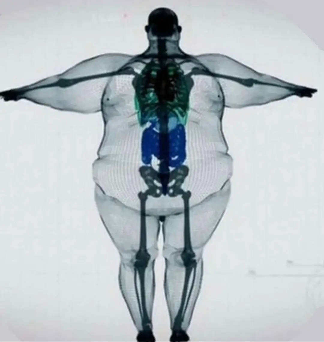 What you’re looking at is a 3D rendering of a 700+ lb (317 kg) man, and a skeleton being pushed to its limit. Bones are built to carry a load, but at this weight, the strain on joints, the spine, and the cardiovascular system is extreme. For patients this means: chronic pain, joint degeneration, reduced mobility, and elevated risk for heart disease, respiratory failure, and diabetes. For providers: the physical demands of lifting, repositioning, or transporting bariatric patients can result in serious injuries without proper equipment and support. This is a medical crisis, not just a number on a scale.