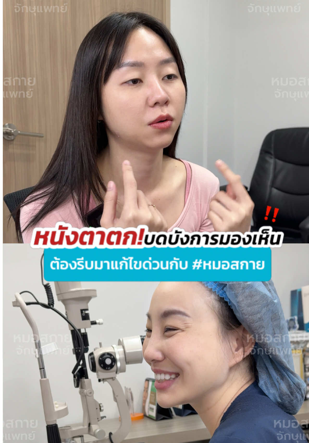 หนังตาตก‼️ บดบังกานรมองเห็น  #หนังตาตก #หนังตาเยอะ #ทําตาสองชั้น  #หมอสกาย #จักษุแพทย์ #หมอตา #สกายคลินิก #ทำตาที่ไหนดี   #skyclinic #ศัลยกรรมตา