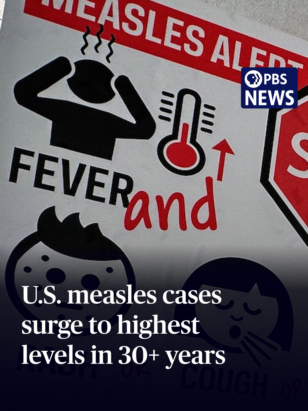 Measles cases surge to highest levels in over 30 years, CDC data shows CDC data shows 2025 is now the worst year for measles cases in this country in more than three decades. More than 150 people have been hospitalized due to the growing outbreak and three have died, including two unvaccinated children in Texas. Amna Nawaz discussed more with Dr. Adam Ratner, author of Booster Shots: The Urgent Lessons of Measles and the Uncertain Future of Children's Health.