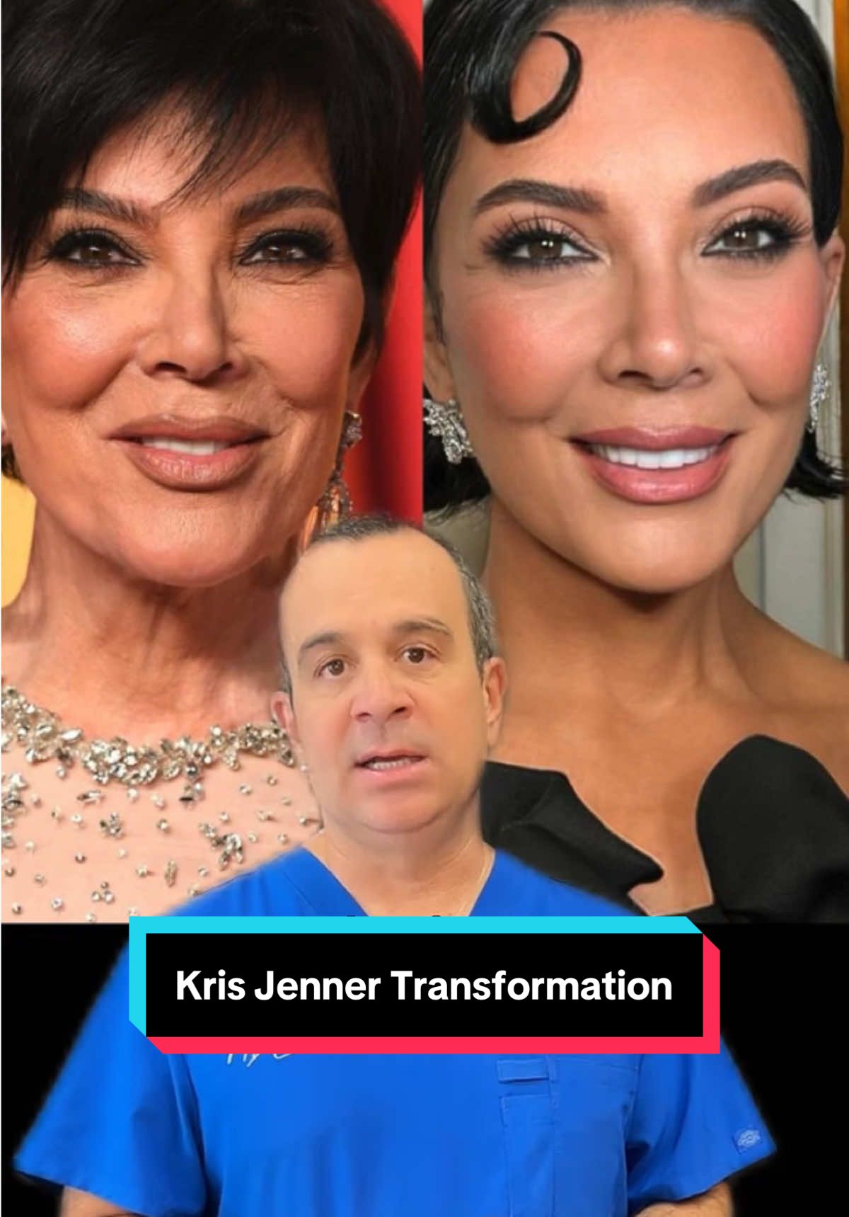 Τελικά τι επεμβάσεις έχει κάνει η Kris Jenner; Ό,τι κι αν έχει κάνει πάντως, το αποτέλεσμα είναι εντυπωσιακό! #drmoustakis #mdclinics #krisjenner #hollywoodnews #krisjennerchallenge #krisjennertransformation #fyp #foryou