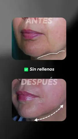 ¿Flacidez en la zona mandibular? Con Morpheus8 trabajamos directamente sobre los jowls, estimulando colágeno desde dentro para recuperar firmeza y redefinir el contorno facial. Sin rellenos. Sin cirugía. 📍 Resultados reales en Elebelle. Agenda tu evaluación personalizada. #Tacna #peru #chile #liftingfacial #rejuvenecimientofacial #bellezanatural #estetica #rejuvenecimiento #morpheus8treatment #cuidadodelapiel 