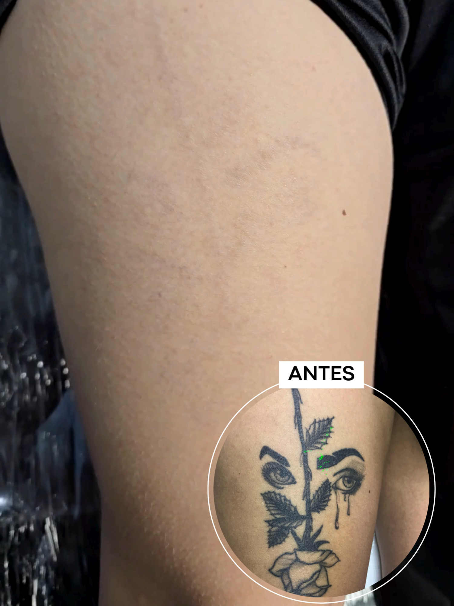 Resultado de remoção de tatuagem na coxa #remocaodetatuagem #tattooremoval #HellTattoo #fyp