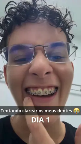 Finalmente achei um jeito de clarear meus dentes mesmo usando aparelho!👌🏻