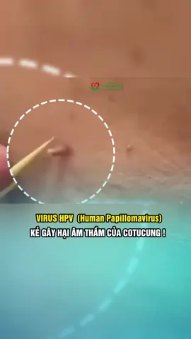 HPV !!! ##bacsiluyenphukhoa #viral_video #phukhoa #foryou #kinhnguyet #hanoi #bacsi #fypシ #hoidapsuckhoe #suckhoe #foryoupage #candida #vlt #fyp #viral #hpv #viemnhiem #viralvideo #video