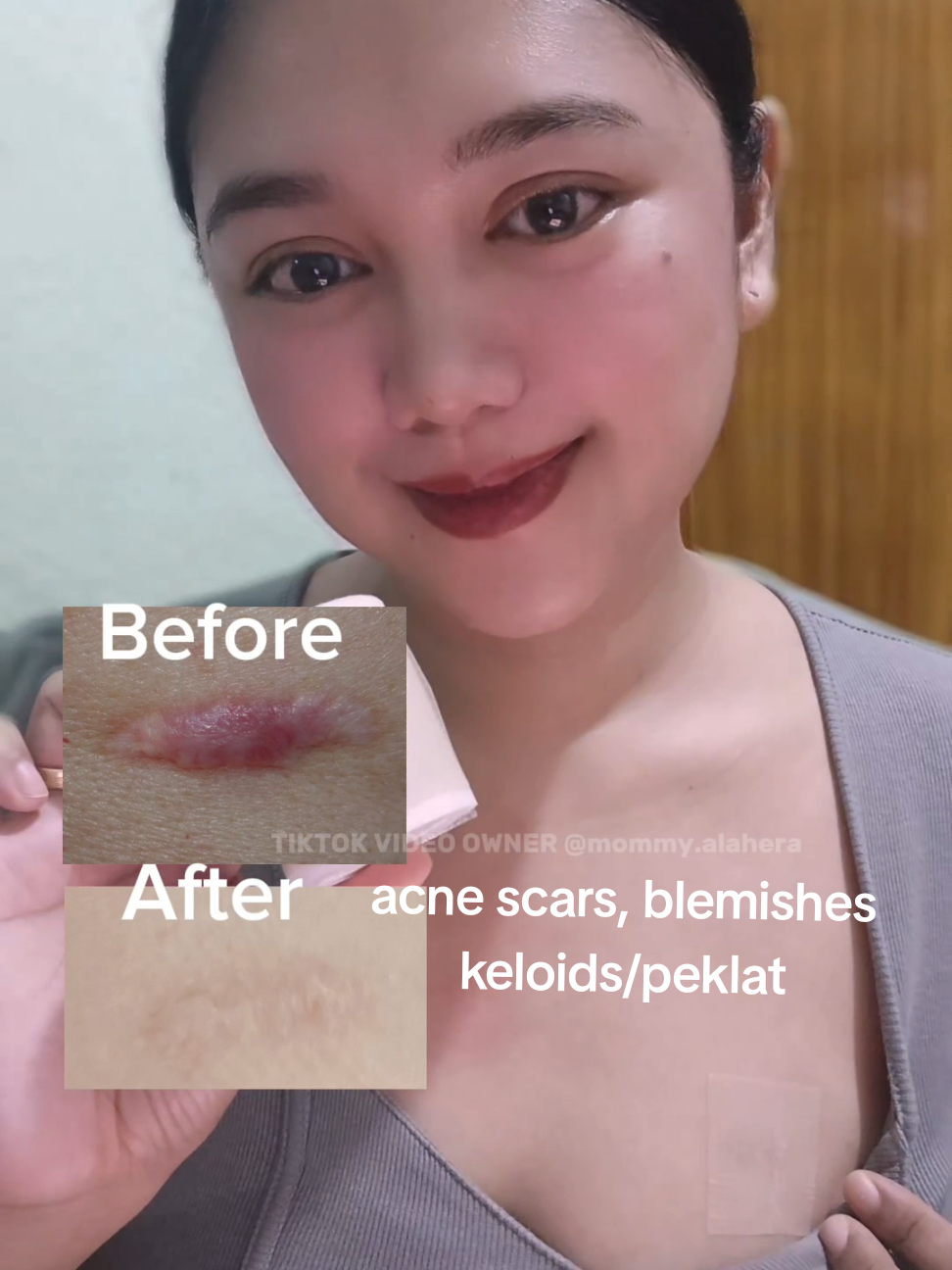 trust the process🥺😍🙏🖐 #siliconescar #siliconescarsheets #scarremover #scarremoval 