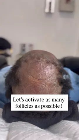 What you see here is a clear example of advanced scarring alopecia, a condition where inflammation destroys hair follicles and replaces them with scar tissue. Over time, this leads to permanent hair loss in the affected areas. It is extremely important to begin treatment as soon as you notice your hair thinning or balding. Don’t try to mask it today…bc you may not be able to mask it tomorrow.  Comment “HELP” if you are experiencing hair loss  #HairRestoration #CCCA #HairLossSolutions #Trichologist #hairjones411 #WomensHairLoss  #AlopeciaAwareness #hair #hairregrowth #hairgrowth #viral  #tractionalopecia #telogeneffluvium #aga #hairtransplant  #haircare  #exploremore #dallashairclinic #hairclinic  #hormoneimbalance #explorepage #thyroid #folliculitis #sundaymotivation #hairloss #prp #explore #alopecia #saturday #weekend