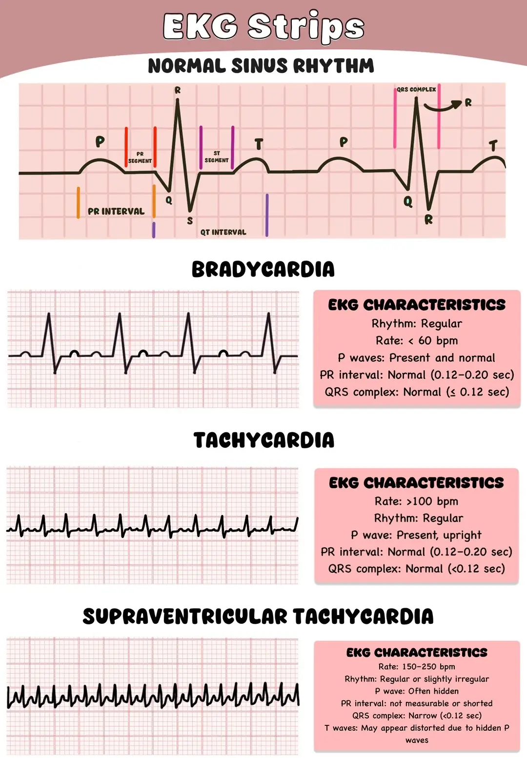 #notes #ekgstrips #ekgrhythms #cardiacnurse #nursingnotes #nursestudent #nurselife 