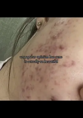 ik it probably hurts and itches but ITS SO PRETTY 😭 #acneproneskin #acneisbeautiful #prettygirls #insecure #acneinsecurity #healtyskin #shinnyskin #badskin #skincare #boysandgirls #fyppp #relatable #viralvideos 