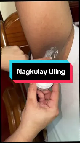 Nakakawala ng self confidence kapag ganito. Kaya samahan nyo ako sa journey ko na mapalighten ua ng pamangkin ko gamit si FRESH FADE CREAM. Be Consistent sa pag gamit walang magic.  #skinamazing #freshfadecream #glutathione #niacinamide #tawas #kalamansi #naturalingredients #underarmcream 