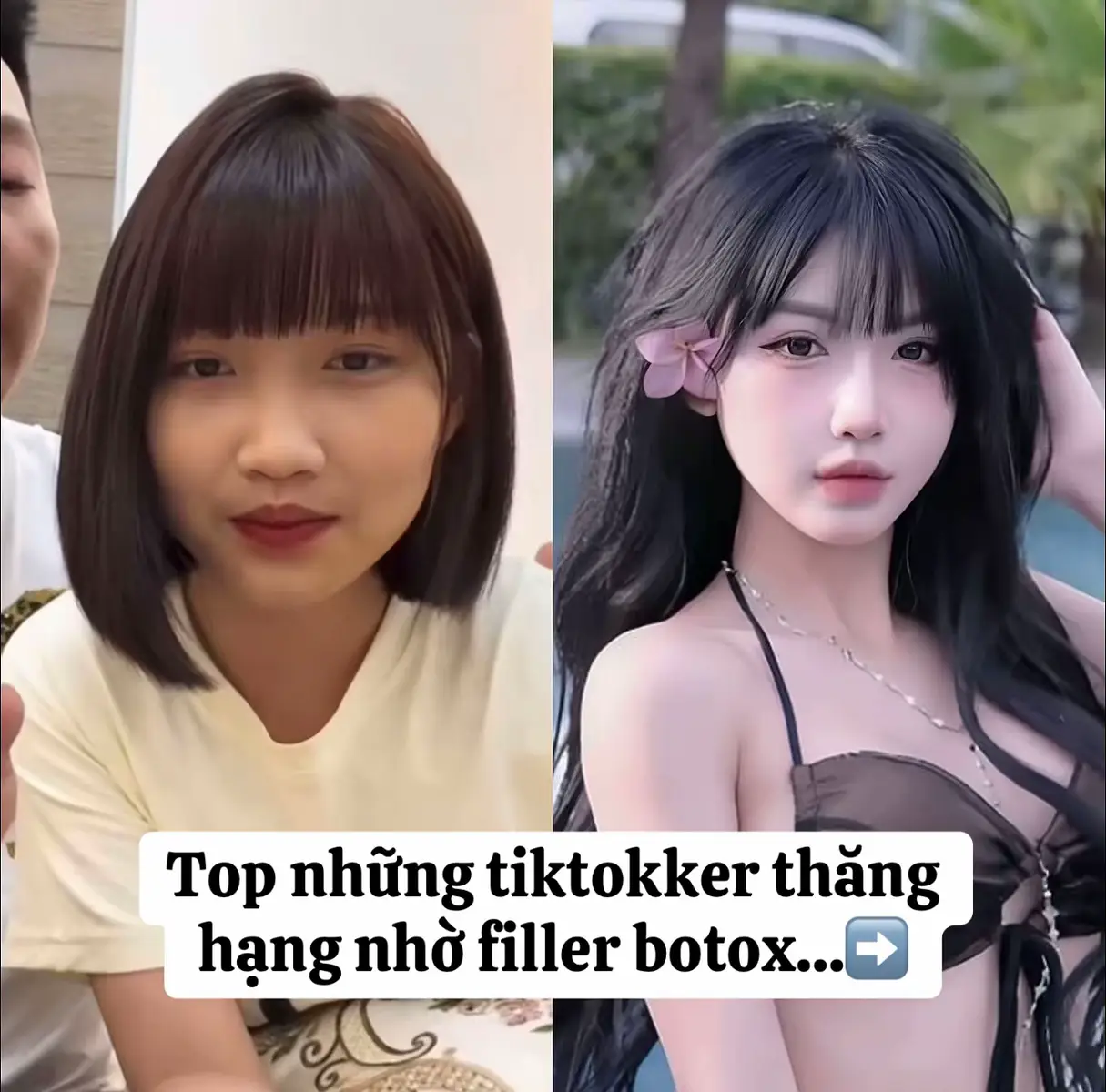 #hoabaybe_beauty99 #HHBeautyAcademy  #fillerbotox #Combofullface #xuhuongtiktok #viral #filler_botox #tiemfiller #tiembotox  #fillermoi 