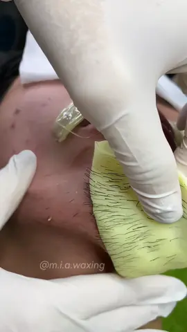 Wax râu cua gái chiêu mới này lợi hại lắm đây #miawaxing #waxlongnongchinhhang #waxlongcaocap #sapwaxchemchep #xuhuongtiktok 
