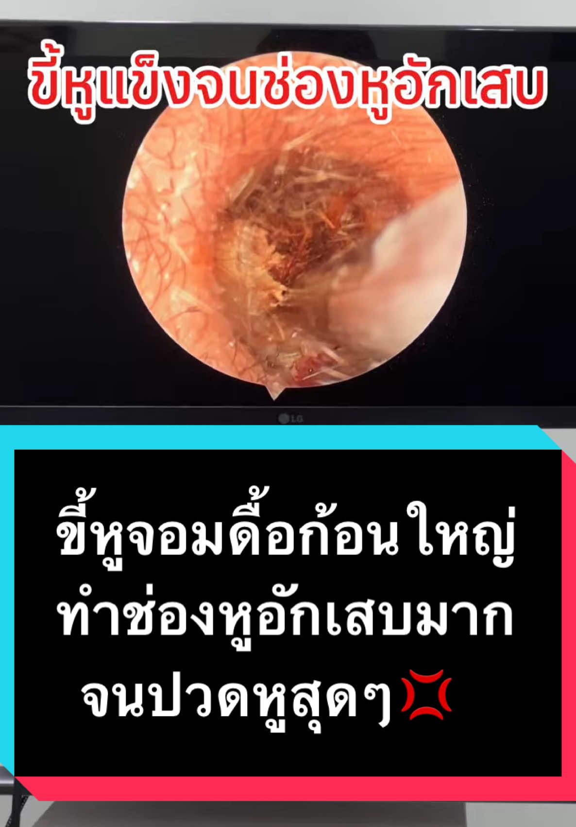 ขี้หูแข็งและดื้อมาก กดเบียดจนหูอักเสบ #รู้จากtiktok #เทรนด์วันนี้ #พี่หมอเปย่าหูคอจมูก #สอนให้รู้ว่า #tiktokuni #คีนท์คลินิกหูคอจมูกอารีย์ #คลินิกล้างหู #keentclinic #ส่องกล้องหูคอจมูก #คลินิกหูคอจมูกกทม #ดูดขี้หู #earwax #สปาหู #แคะหู #ขี้หู #ปวดหู #เวียนหัว #บ้านหมุน #ช่องหูอักเสบ #คันหู 