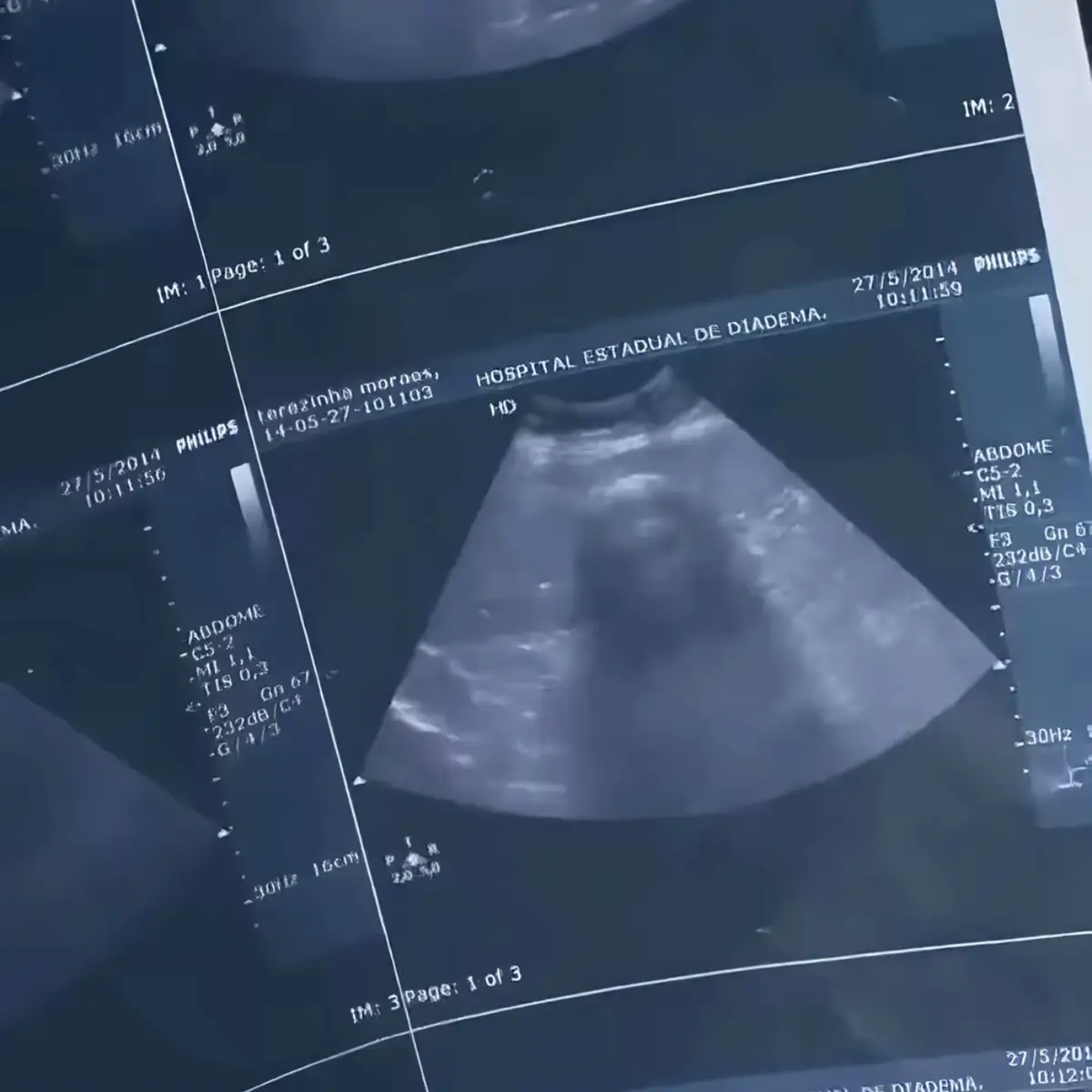 ROSTRO DE MUJER APARECE EN EXAMÉN DE ULTRASONIDO. Tres días antes de morir, Terezinha, de 74 años, se sometió a un ultrasonido. El examen reveló una sorpresa que intrigó a la familia y te intrigará a ti. El ultrasonido muestra con bastante claridad la imagen de una mujer.  ¿Cual será la explicación? ¿Hay alguna explicación para esto? #paranormal #terror #sobrenatural #fantasmas #fantasmasreales #fantasmasentiktok #fantasmascaptadosencamara #fantasmasenhospitales #paranormal #sucesosparanormales 