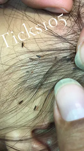 Remove lice #tiktokremixcontest #😱😱😱omg #lice #😭😭😭 #😂😂😂 #tripofobia #liceRemoval #😨😰🥶 #😍😍😍 #😨😰🥶🇺🇸🙏 