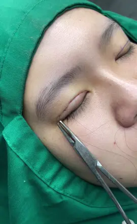 Nếp mí siêu đẹp cho khách iu nhà em #binhduong #nhấnmíNano2lớp #nhanmibinhduong #xuhuong #tiemmoifiller 