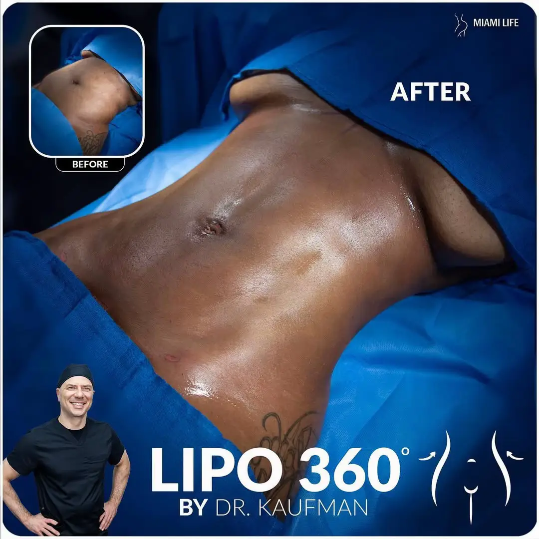 Sculpting Dreams, One Curve at a Time Prepare to redefine your curves with unmatched precision.  Say BYE to stubborn fat and embrace a beautifully sculpted physique. & With Dr. Kaufman's innovative techniques and expertise, achieve the flat abdomen and snatched waist you've always wanted and experience an all-around transformation for a stunning 360- degree look.  Ready to start your transformative journey? E @miamilifeplasticsurgery f DM us now for a free Miami Life Plastic Surgery 8686 Coral Way, Miami FL www.miamilifeplasticsurgery.com Resultados de Lipo 360 por el Dr. Kaufman € E Envianos un mensaje privado ahora para una consulta gratuita  #SculptedBeauty #HDLipo360 #AbdominalEtching #BodyContouring #ConfidenceRevolution #UnlockYourPotential #FollowMeToMiamiLife #plasticsurgeryexpert #plasticsurgeryclinic #plasticsurgeryresults #plasticsurgeryresults #oblsurgery #coralway #miamibeachflorida #Bblresults #kaufmandolls #bodybykaufman #Lipo360 #miamiflorida #miamibeachflorida #jplasma #liposuction #liposculpture