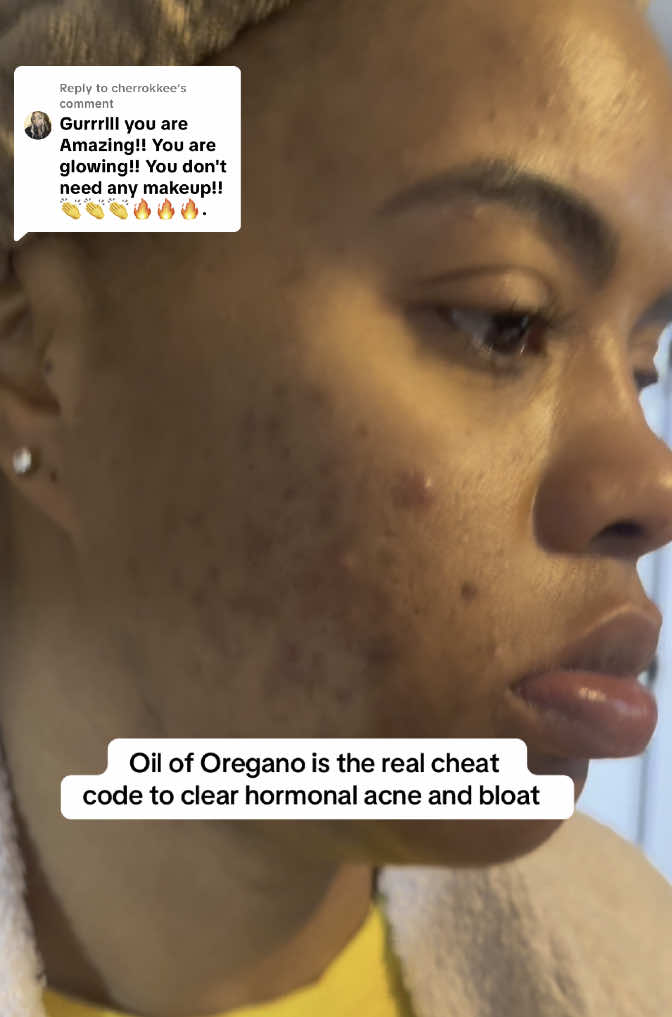Replying to @cherrokkee girl I’m so thankful for this oil of oregano because finally now I have been able to maintain clear skin. #oiloforegano #detox #hormonalacne #bloat #momlife #womenshealth 