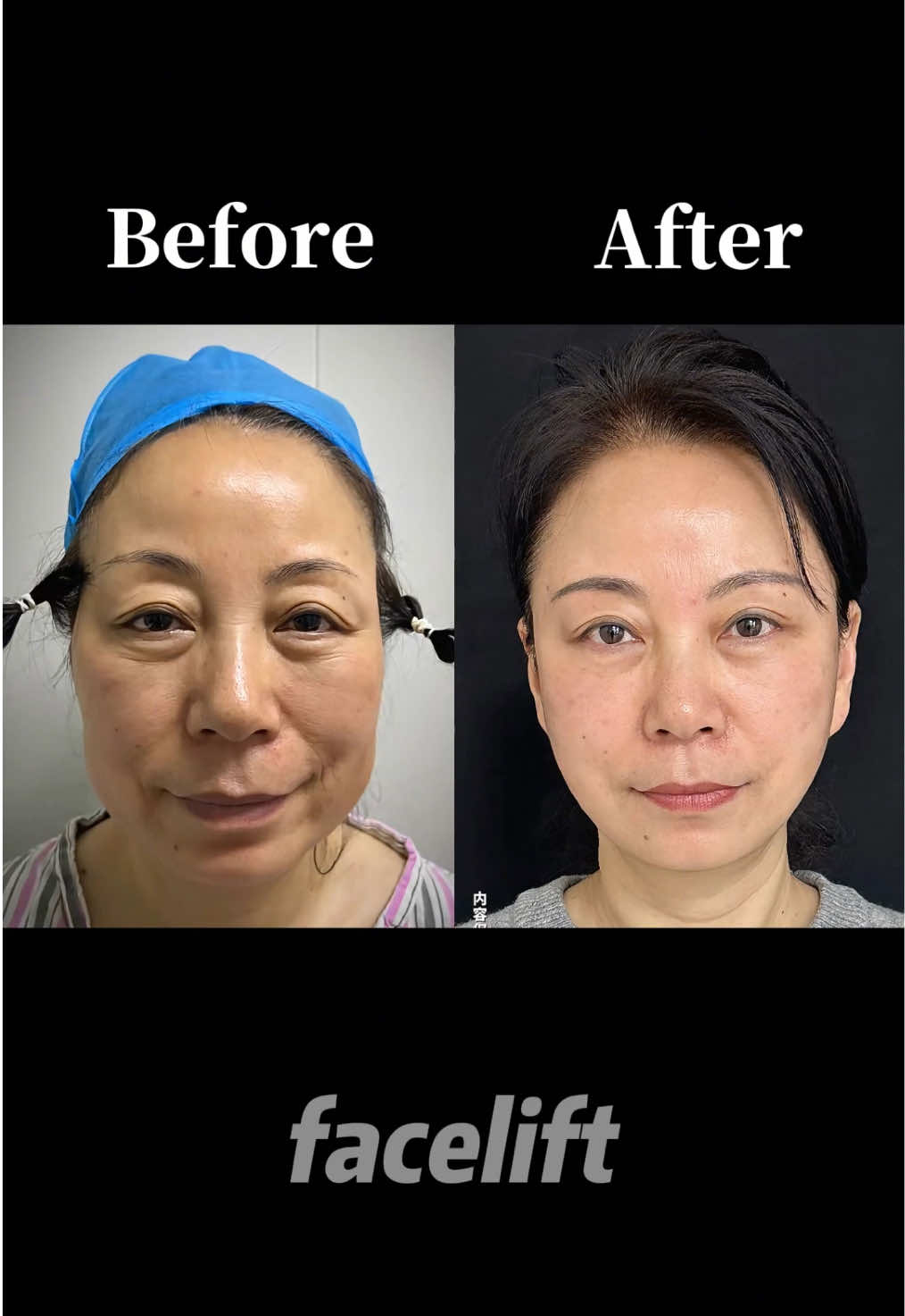 #facelift #antiaging #facelifting #拉皮 #筋膜提升 