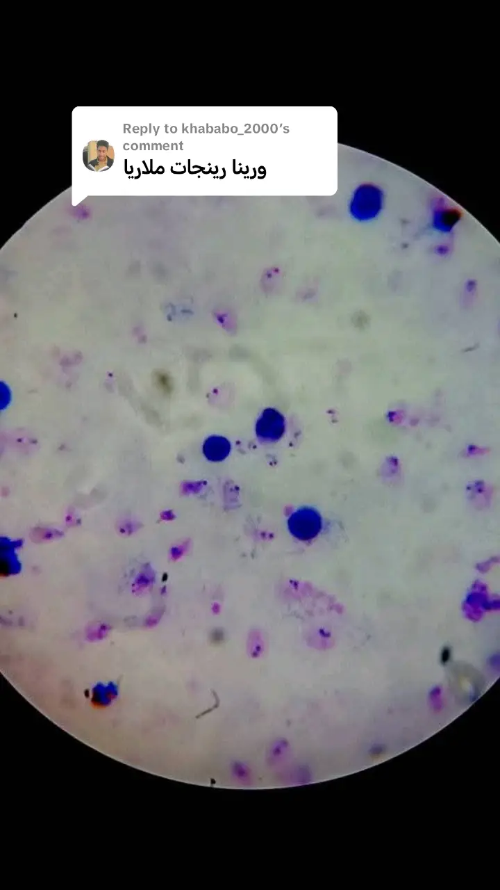 Replying to @khababo_2000 Ringe stage of plasmodium falciparum🔬 #foryoupage #student #explore #microscope #السودان🇸🇩 #الشعب_الصيني_ماله_حل😂😂 #mltiktok #سودانيز_تيك_توك #fyp #viralvideos #viralsong 
