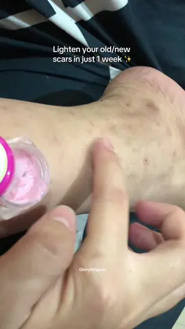 In just 7 weeks! Looks how it lightens the scars ✨ #scarremover #scar #peklat #peklatremover #verdefy #verdefyscarremovercream #whiteningcream #whitening 