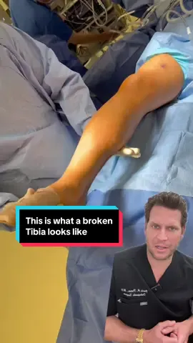 Ever wonder what a broken tibia actually looks like?🦴 In this OR clip, Dr. Porter demonstrates just how unstable the leg becomes when the tibia is fractured — no strength, no support, and zero ability to bear weight. It’s a powerful reminder of why surgical stabilization is often necessary — and how precise care leads to real recovery! Schedule Your Consultation Today! Progressive Spine & Orthopaedics 📲 201-227-1299 💻 www.progressivespine.com NEW JERSEY LOCATIONS: 📍Englewood (Bergen County) 📍Edison (Middlesex County) 📍Clifton (Passaic County) 📍Cherry Hill (Camden County) 📍Brick (Ocean County) 📍Somers Point (Atlantic County) 📍Fort Lee (Bergen County)  PENNSYLVANIA LOCATIONS: 📍Philadelphia 📨 Direct Message us if you have any questions #ProgressiveSpine #Orthopedics #BrokenTibia #TibiaFracture #DrPorter #OrthopedicSurgery #LegInjury #FractureRepair #BoneHealth #SurgicalCare #InjuryRecovery #MusculoskeletalHealth #OrthoCare #OrthopedicSurgeon #FractureFixation #TraumaSurgery #LegStabilization #SpineAndOrtho #InTheOR #PatientRecovery #StrongBones#greenscreenvideo 