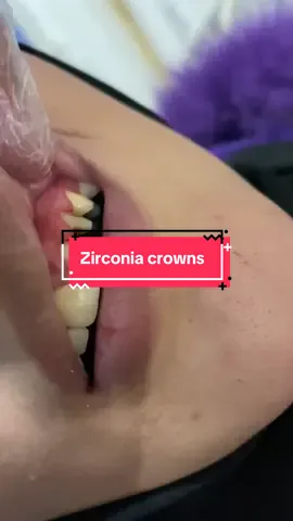 Part 11(zirconia crowns #creatorsearchinsights #foryou #foryoupageofficiall #dentist #dentalcare #dentist 