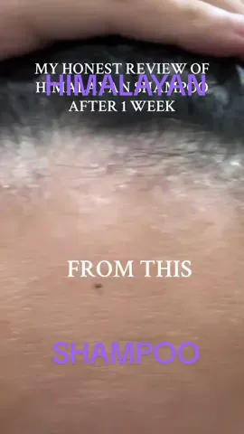 Effective ngaaaa!  #dandrufttips, #haircare, #naturalremedies, #diyhaircare, #hairtok