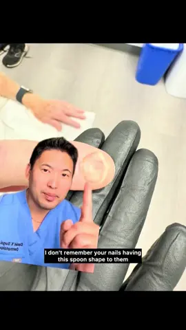 Dermatologists also specialize in hair and nails which definitely reflect our internal health. Be sure to avoid nail polish or any nail products before seeing your dermatologist for a skin check! Very cool to see this patient in follow-up after having improvement in his iron deficiency anemia and also observing less noticeable dips in their nail plate (still a bit spoon-shaped but much less noticeable)! Of note, it takes about 6 months to grow a new fingernail and 12 months to grow a new toenail (nails tend to grow faster in the summer).  #LearnOnTikTok  #nails #nailcases #drsugaiskincare #evidencebased #dermatologist #irondeficiency #irondeficiencyanemia #anemia #koilonychia 