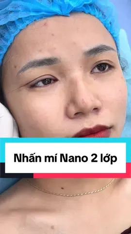 Sở hữu ngay 1 đôi mắt đẹp chỉ sau 20 phút thực hiện với công nghệ nhấn mí Nano #nhanmi #nhanmitunhien #nhanminano2lop #nhanmitunhien #xuhuong #ilovetiktok 