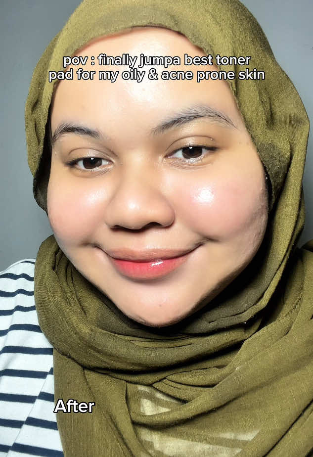 After consistent pakai g2g acne toner pad ni my skin dah semakin better yaa dah nampak flawless🙈 Lurveee sangat you guys should try😍 #acnetonerpads #exfopadsviral #g2gacnetonerpads #g2gmy #skincarehack 