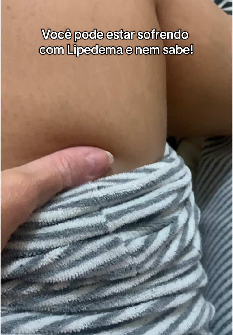 Comenta aqui se você tembém sofre de lipedema? 