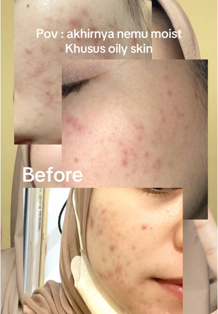 Best moist penyelamat aku dari kulit aku yg breakout + oily skin!! Thx to moist biru skintific 🥺💘