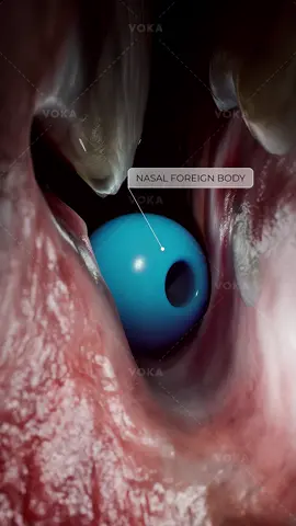 What makes nasal foreign bodies so troublesome? Why nasal foreign bodies demand attention?  A foreign body in the nose is more than just a nuisance—it's a common medical concern, especially in curious children who explore the world hands-on. When left unchecked, it can lead to uncomfortable symptoms and potential complications.   These tiny intruders trigger a cascade of local reactions:   🔹 Unilateral nasal congestion – One blocked nostril is a classic red flag   🔹 Foul-smelling discharge – Often the first sign parents notice   🔹 Inflammatory response – The body's defense mechanism kicks into high gear     Here's what happens at the tissue level:   🔻 Mucosal infiltration – Immune cells swarm the area to combat potential infection   🔻 Hyperemia – Blood vessels dilate, causing redness and swelling   🔻 Purulent secretions – The nose produces pus-like discharge as bacteria multiply   Early removal is crucial to prevent complications like sinus infections or tissue damage!   📌 Want to visualize this process in stunning detail? Explore nasal anatomy and foreign body management with VOKA 3D Anatomy & Pathology!   #ENT #pediatrics #nasalforeignbody #otorhinolaryngology #3D #3Danimation #3Dmedicalanimation #3danatomy #medstudents #medicaleducation #anatomy #pathology #3danatomy #digitallearning #humanbody