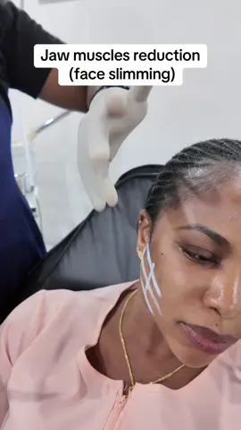 Ever feel like your face looks heavier or squarer than you’d like even when your body feels slim?  Sometimes, it isn’t fat, it’s just overactive jaw muscles. With gentle Botox in the masseter area, we can softly slim and contour your lower face, giving you a softer, V-shaped silhouette without surgery, downtime, or losing your natural beauty.  #botox #botoxnatural #faceslimming 
