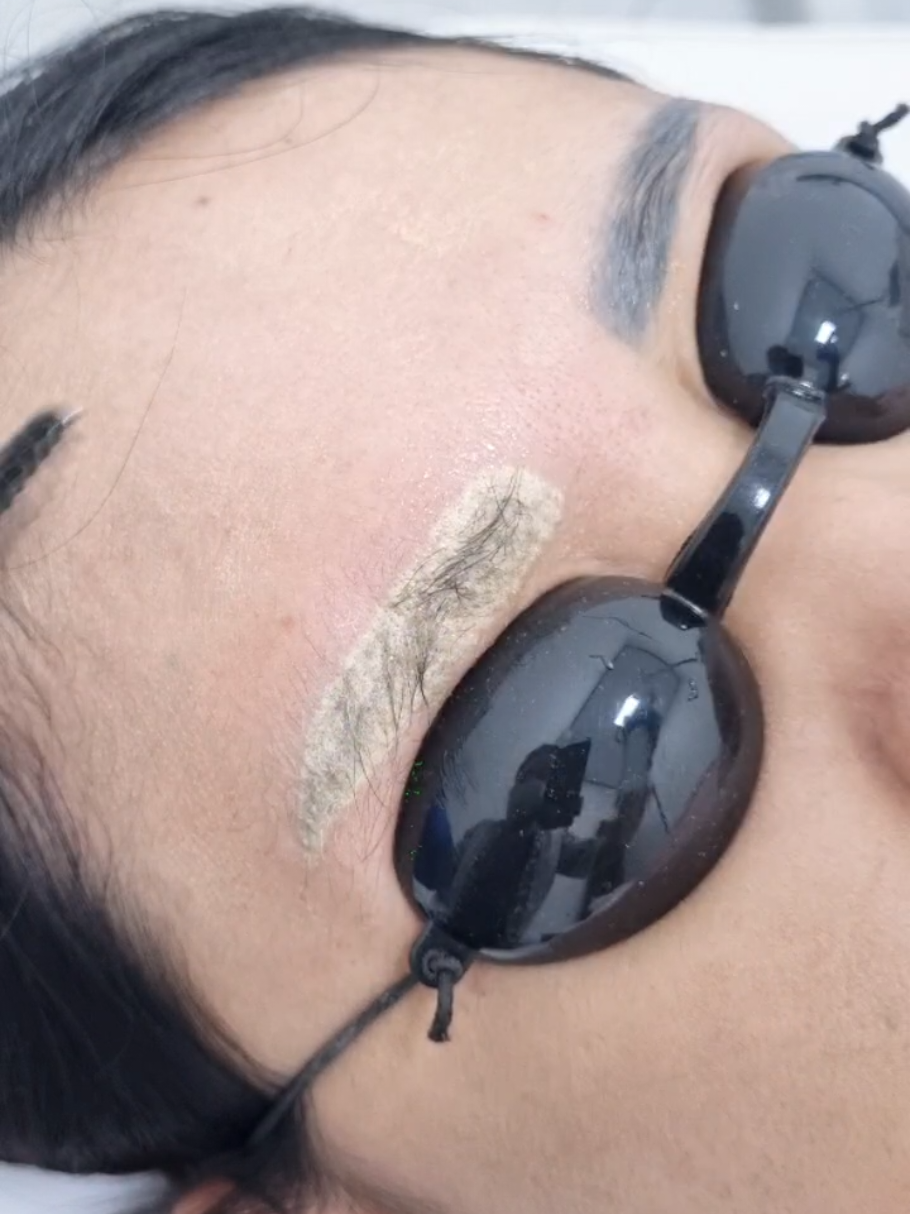 Hapus sulam alis #hapustato #tattooremoval #sulamalis #hapussulamalisgagal #hapussulamalis  #removaltattoo #hapustatojakarta #rumahhapustato #hapustatolaser #spesialishapustato #jakartatimur #jakarta #hapustattoo 