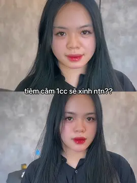 tiêm cằm thui mà đẹp quá nè #camtron #tiemcam #filler_botox 