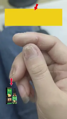 ¡Da nueva vida a tus uñas con nuestro sérum de jengibre revitalizante! Este innovador sérum, enriquecido con vitaminas B y extractos botánicos, está diseñado para reparar y fortalecer las uñas dañadas. Su fórmula avanzada trabaja en profundidad para restaurar la salud de tus uñas, prevenir quiebres y fomentar un crecimiento saludable. Cada aplicación te proporcionará uñas más fuertes y radiantes. ¡Un pequeño frasco, un gran efecto, y el mejor cuidado para tus uñas!#Vitaminab #Molinosharineros  #TikTok #Lasuñas #VentaQuincenal
