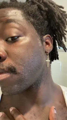 Like as you can see I’m breaking out and it’s lowkey unavoidable but I can just let it grow out and the inflammation will go away. Whereas in the service having to have a fresh shave Monday morning is where the scarring and issues can occur. #blackmen #straightrazorshaving #usmc #veteran #pseudofolliculitisbarbae 