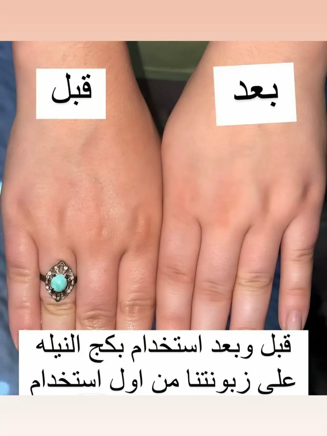 تبين بياض ونعومة من أول تجربة؟ جربي سر ملكات المغرب!🇲🇦  النيلة الزرقاء💙 ليش النيلة الزرقاء ؟ لأنه حجر طبيعي %100 يتم طحنه واستخدامه للبشرة لحل لشاكل عديدة ، له قدرة عجيبة في تفتيح وتوحيد لون البشرة، يعطي شعور منعش ونعومة فائقة ويفتح مسامات الجلد ويرطبه بعمق، يشد البشره خصوصا المترهلة و التي تعاني من التمددات