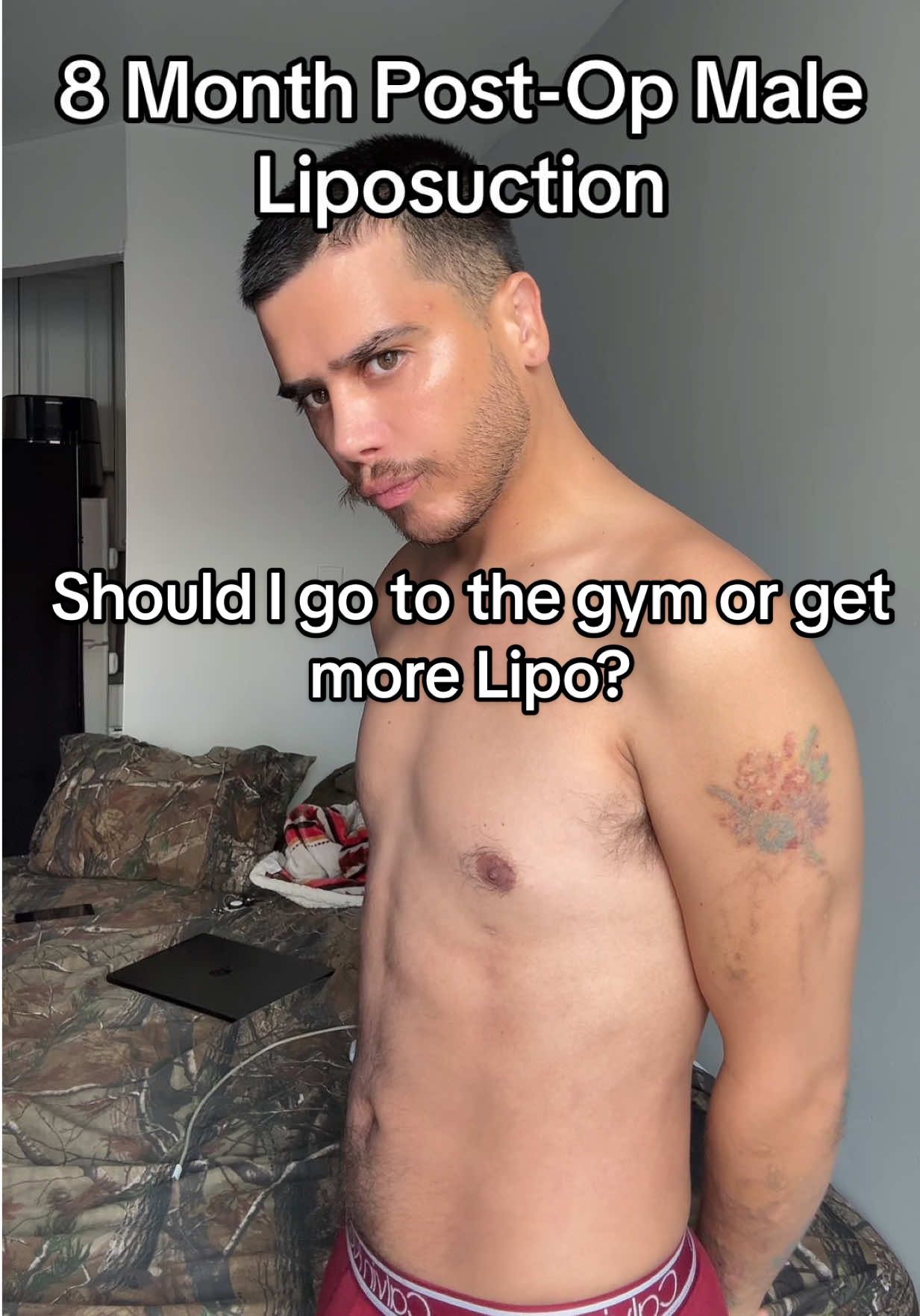 Today marks 8 months post-op from my male liposuction. I had lipo done on my waist and stomach. I’ve been thinking about doing another round of lipo in a year, this time with skin tightening. I’m kind of stuck though should I focus on hitting the gym consistently, or just go ahead and do the skin tightening? Not sure what to do. What do you think? #lipo #lipo360 #malelipo #liposuction #liporesults #plasticsurgery #gaytiktok #lgbt #vaserlipo 