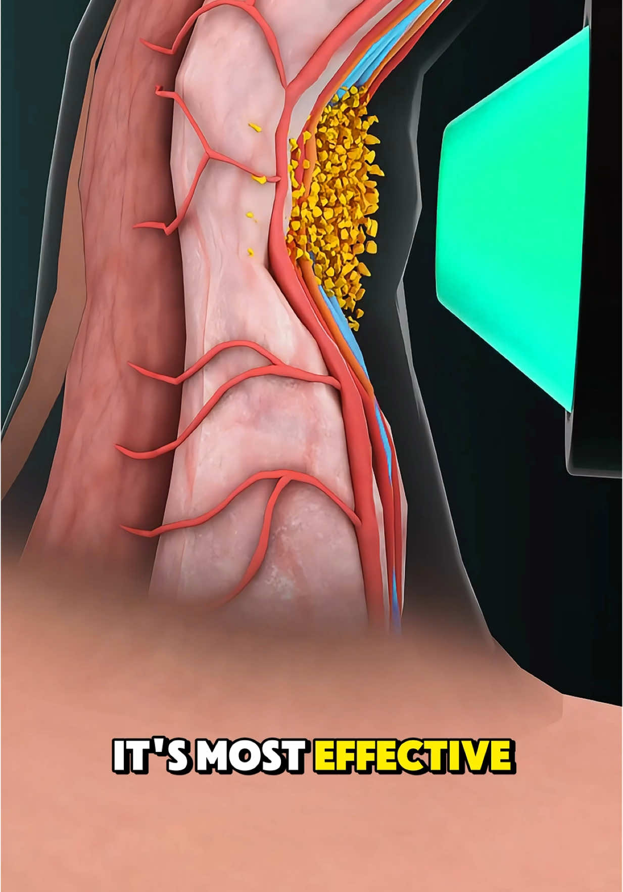 How Shockwave Therapy Treats Peyronie’s Disease (3D Animation) #peyroniesdisease #peyroniestreatment #peyroniesawareness #peyronie #peyroniesdiseasetreatment #peyroniesawareness #medical3danimation #3dmedicalanimation 