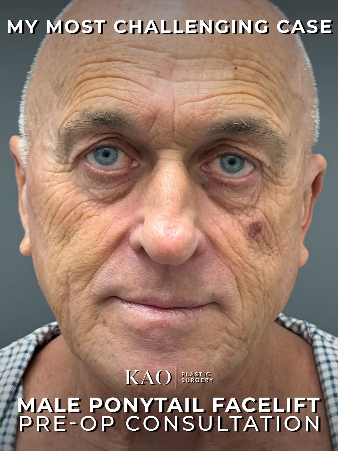 My Most Challenging Case: Ponytail Facelift for a Bald Patient The case of a first-time patient… One who has never before had any type of cosmetic procedure. This is the most difficult operation I have ever performed in my entire career as a board certified plastic surgeon. A vibrant 61-year-old man was seeking facial rejuvenation for concerns that the visible signs of aging—deepening lines and tissue laxity—no longer reflected his internal youth and vitality. The biggest obstacle, obviously, was his complete baldness. A traditional facelift, whether a deep plane or high SMAS technique, relies on incisions strategically placed in front of the ear, around the earlobe, and hidden within the temporal and post-auricular hairline. Without hair, these scars would be fully exposed. For male patients, the goal is an outcome that appears natural and effortless. Visible scars create an unnatural appearance, undermining the subtle rejuvenation. The results must be powerful yet inconspicuous. So I asked myself: How do I perform a Ponytail Facelift… on a bald man? How do we deliver the significant, transformative rejuvenation expected by the patient without the traditional incisions? Conventional techniques could not meet this patient's unique anatomy. An innovative solution was required. So we had to brake every rule in the book. In the next video we will detail the novel surgical approach we developed to perform this complex procedure and reveal the patient's unbelievable final results! #PonytailFacelift #PonytailLift #beforeandafter #santamonica #facelift #aestheticvibes #behindthescenes