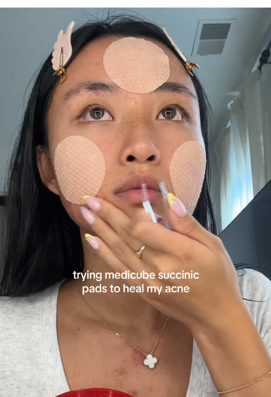 hoping my angry acne calms down soon bc she needs to gooo and be happy #acne #acneproneskin #acneskincare #acnejourney  @medicube global red succinic pads  @Tatcha US lip mask  @Emi Jay hair clips