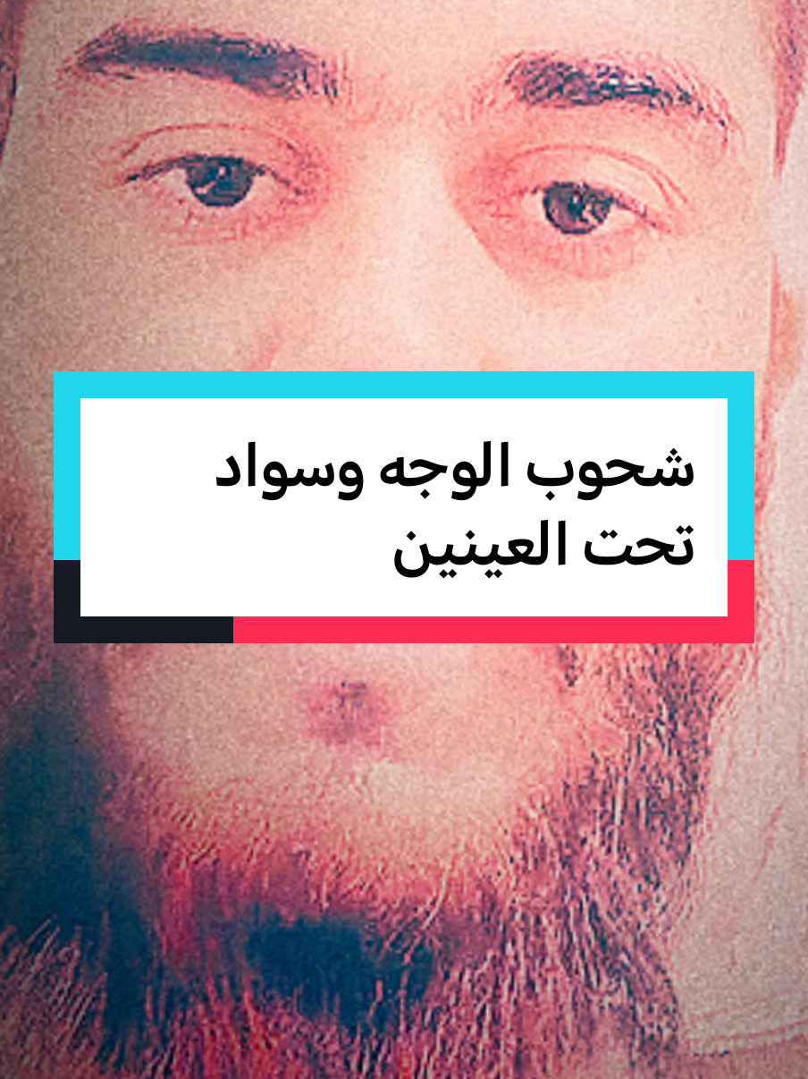 شحوب الوجه وسواد تحت العينين #fypシ #fypviralシ #فهدالقرني 